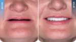 Diş implantı öncesi ve sonrası sonucu