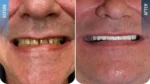 Diş veneer uygulaması öncesi ve sonrası sonucu