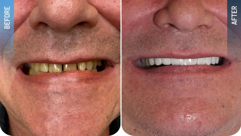 Diş veneer uygulaması öncesi ve sonrası sonucu