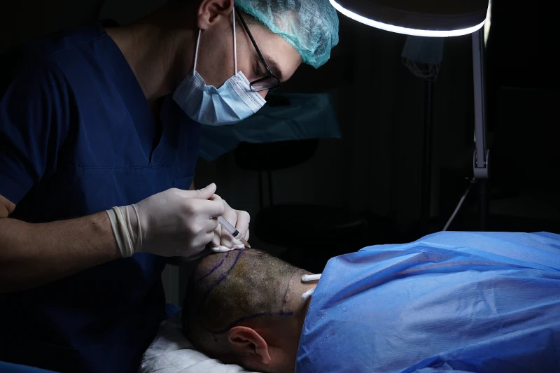 Local anesthesia before hair transplant procedure