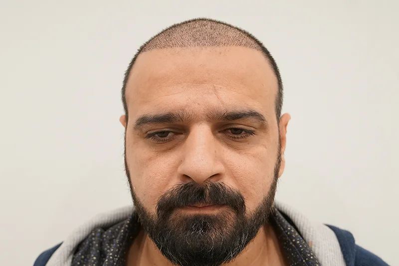 Initial hair transplant result after the first month