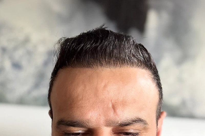 Natural front hair transplant result
