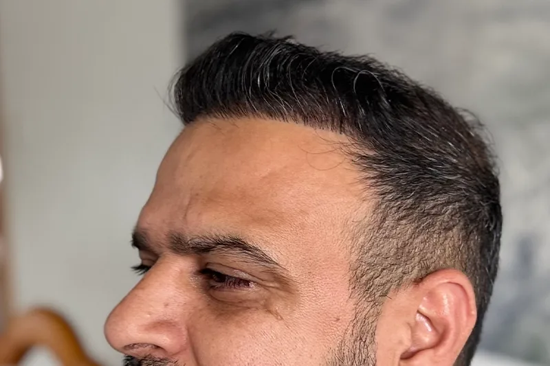 Natural hair transplant result from the left angle
