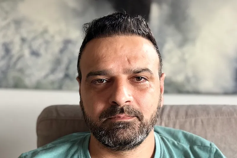 Overall appearance after hair transplant