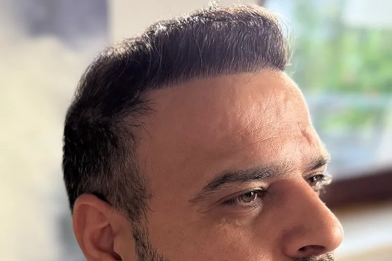 Natural hair transplant result from the right angle