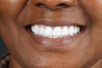 Close-up Hollywood Smile result after treatment