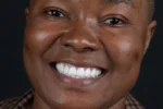 Hollywood Smile front result after treatment