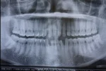 Panoramic dental x-ray before Hollywood Smile treatment