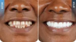 Zirkonyum kaplama ile Hollywood Smile öncesi ve sonrası sonucu
