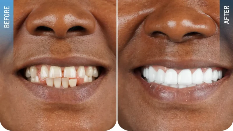 Zirkonyum kaplama ile Hollywood Smile öncesi ve sonrası sonucu