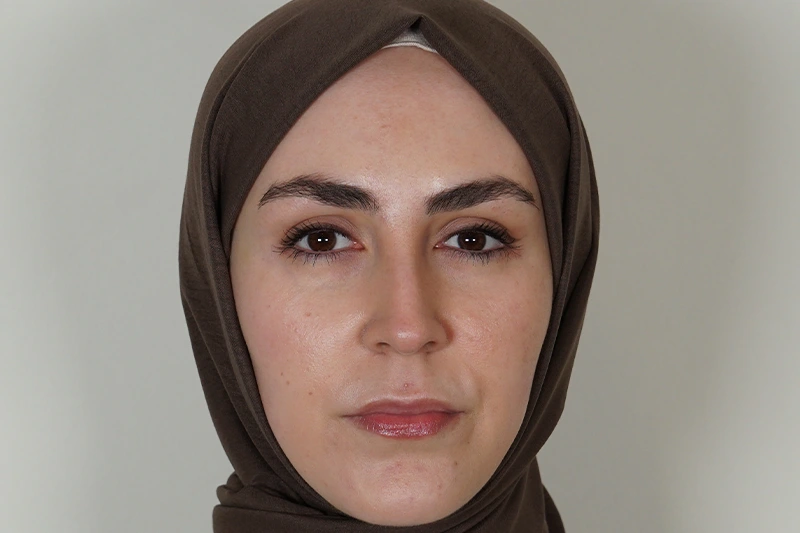Botoks tedavisi sonrasında yüzün önden görünümü.