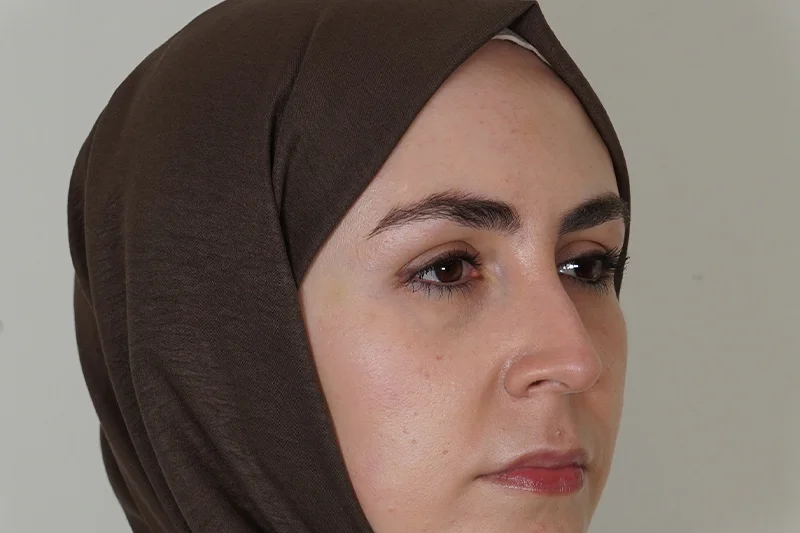 Botoks tedavisi sonrasında yüzün yan profilden görünümü.