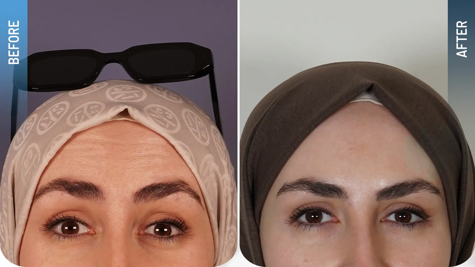Botoks tedavisi öncesi ve sonrası yüz görünümünü karşılaştıran fotoğraf.