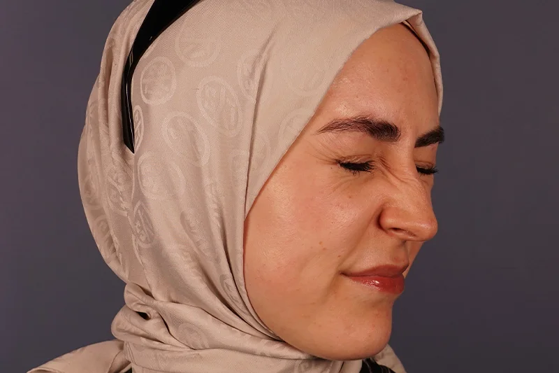 Botoks uygulaması öncesinde yüzün yan profilden görünümü.