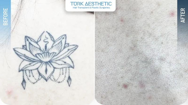 Laser removal of a small flower tattoo on the back before and after