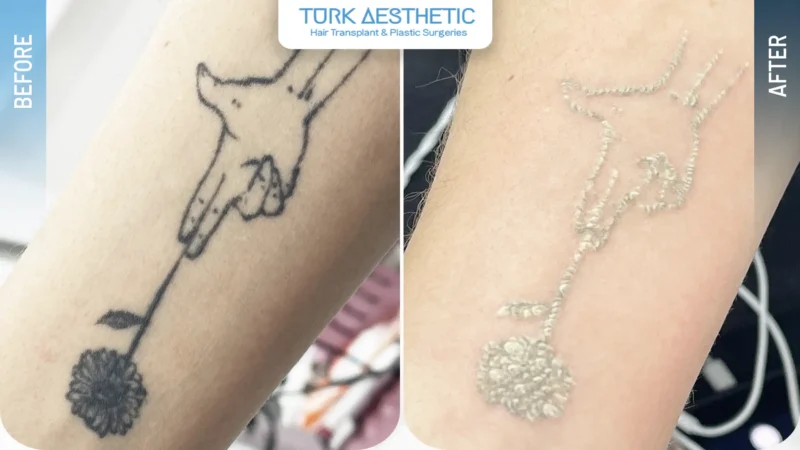 Laser tattoo removal before and after result