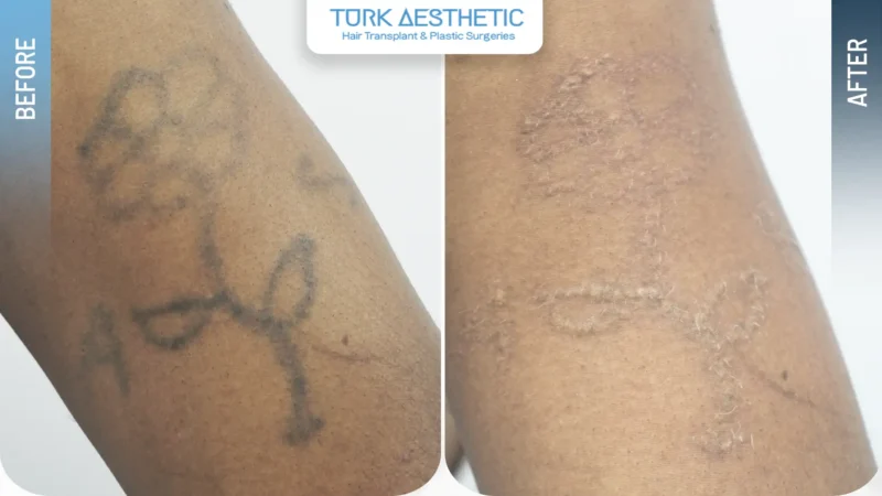 Laser removal of a flower tattoo on the hand before and after
