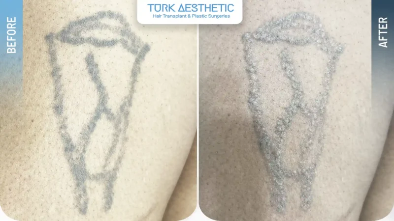 Laser removal of a flower tattoo on the leg before and after