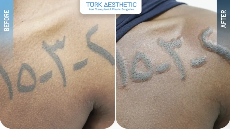 Laser removal of a letter tattoo on the arm before and after