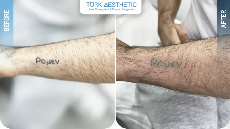 Laser removal of a letter tattoo on the arm before and after