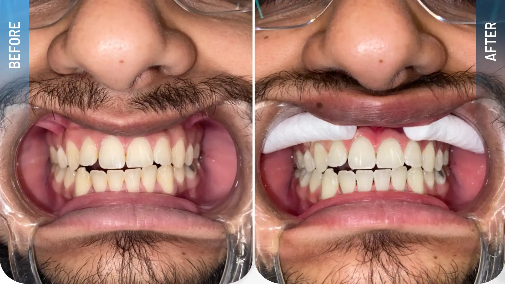 Vorher-Nachher-Vergleich einer Laser-Zahnaufhellung mit einem helleren und weißeren Lächeln.