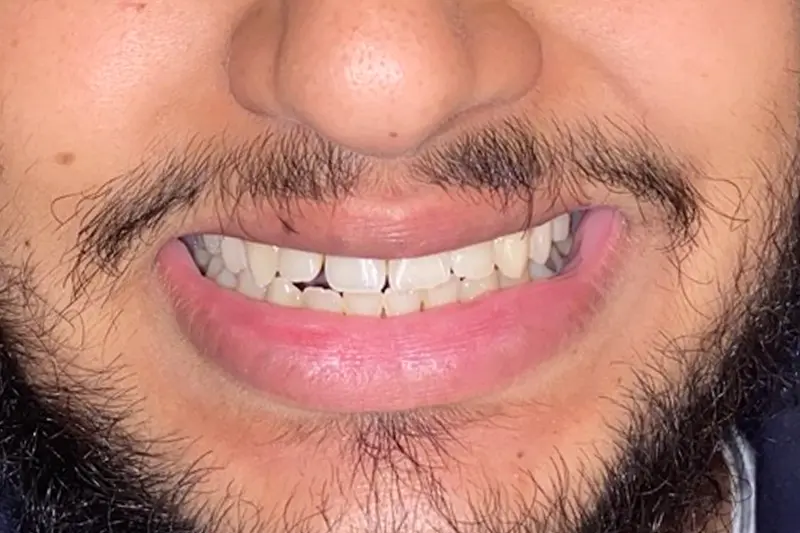 Helleres Lächeln nach einer professionellen Laser-Zahnaufhellung.