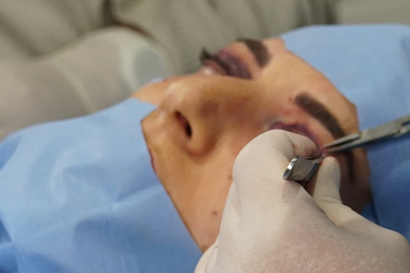 Göz kapağı ameliyatı sırasında cerrahi işlem.