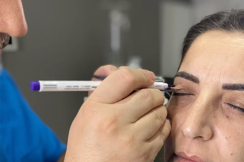 Doktorun ameliyat öncesinde üst göz kapağındaki fazla deriyi değerlendirmesi