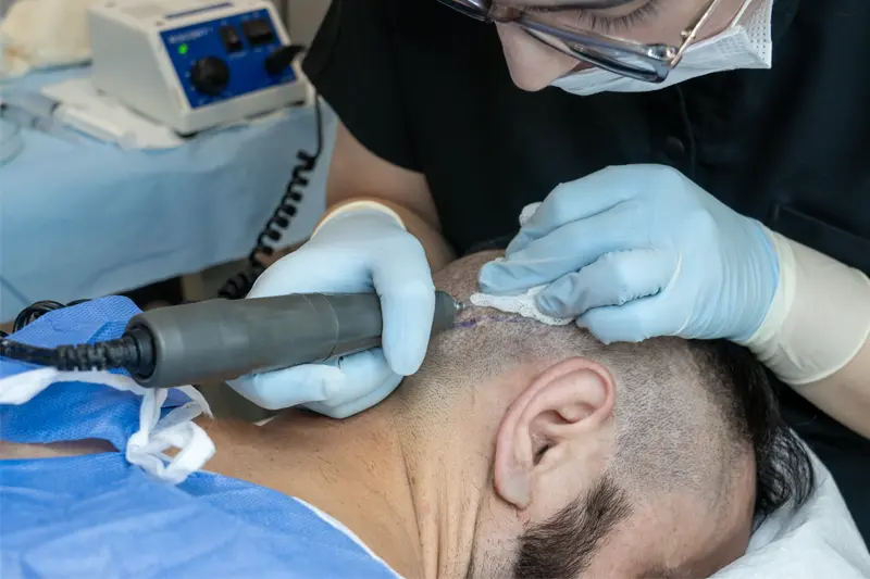 FUE hair graft extraction procedure