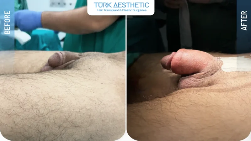 Penis büyütme öncesi ve sonrası ikinci sonuç