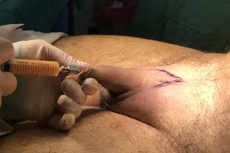 Penis büyütmede yağ enjeksiyonu işlemi