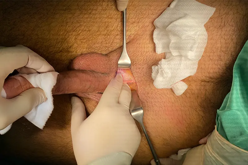 Penis büyütmede bağ serbestleştirme ameliyatı