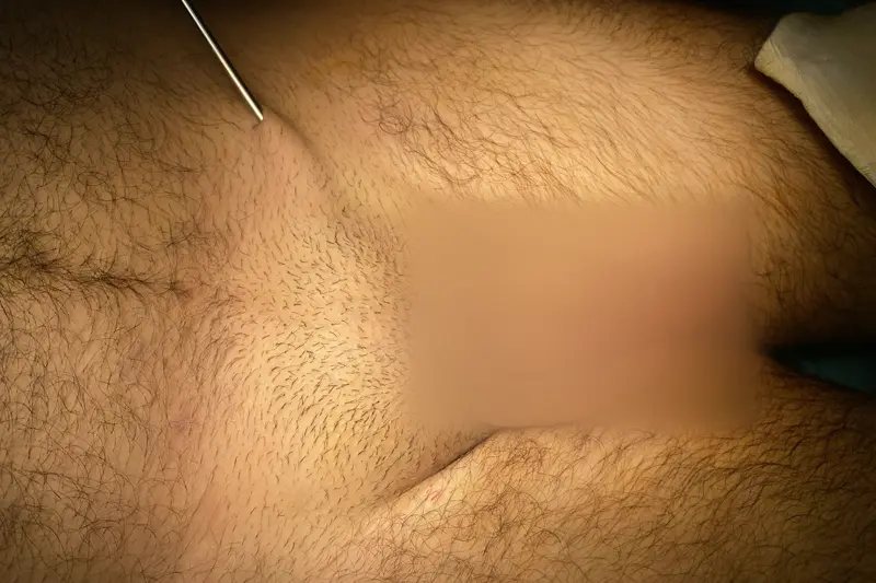 Penis büyütme için pubis bölgesi liposuction işlemi