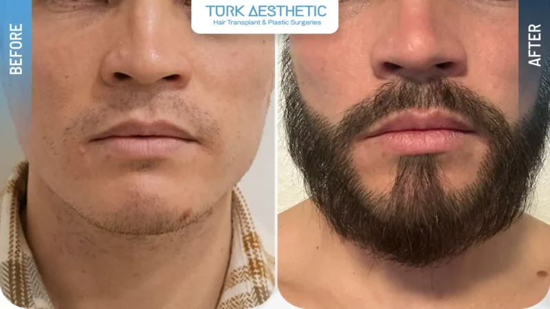 Comparación entre las zonas poco pobladas antes del injerto de barba y el aumento de densidad después del procedimiento