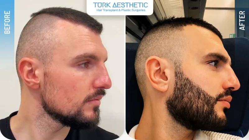 Comparación antes y después que muestra el cambio de densidad en la zona de la barba