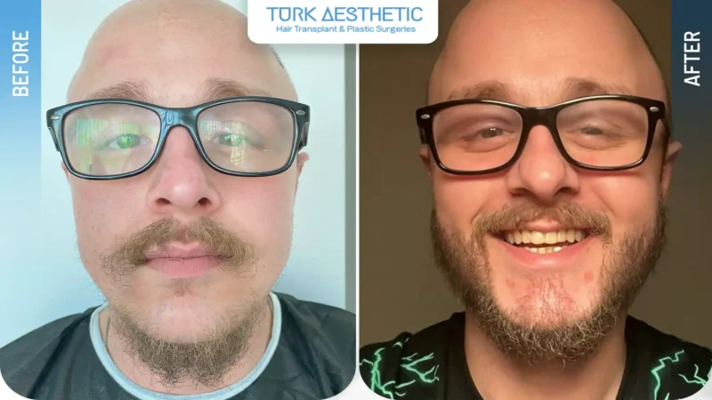 Comparación entre los espacios de la barba antes del injerto y su aspecto natural después del procedimiento