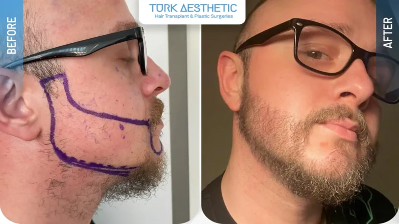 Comparación entre una barba poco poblada antes del injerto y una apariencia más densa después del procedimiento