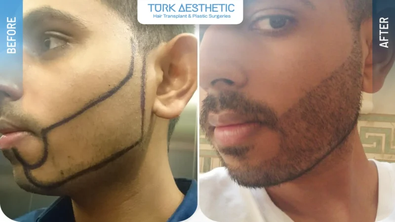 Comparación entre una barba escasa antes del injerto y un resultado armonioso con los rasgos faciales