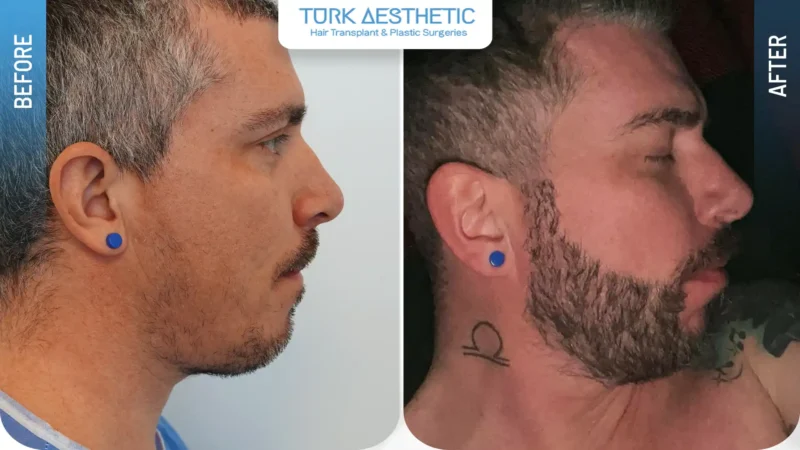 Comparación entre una densidad limitada antes del injerto y una barba más definida después del procedimiento