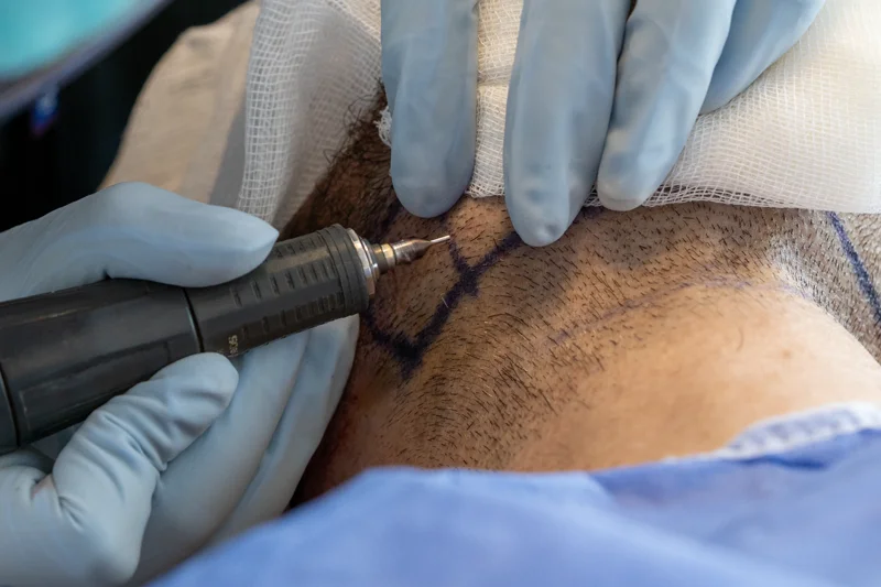 Prélèvement de follicules pileux de la barbe lors d’une greffe de cheveux BHT en Turquie