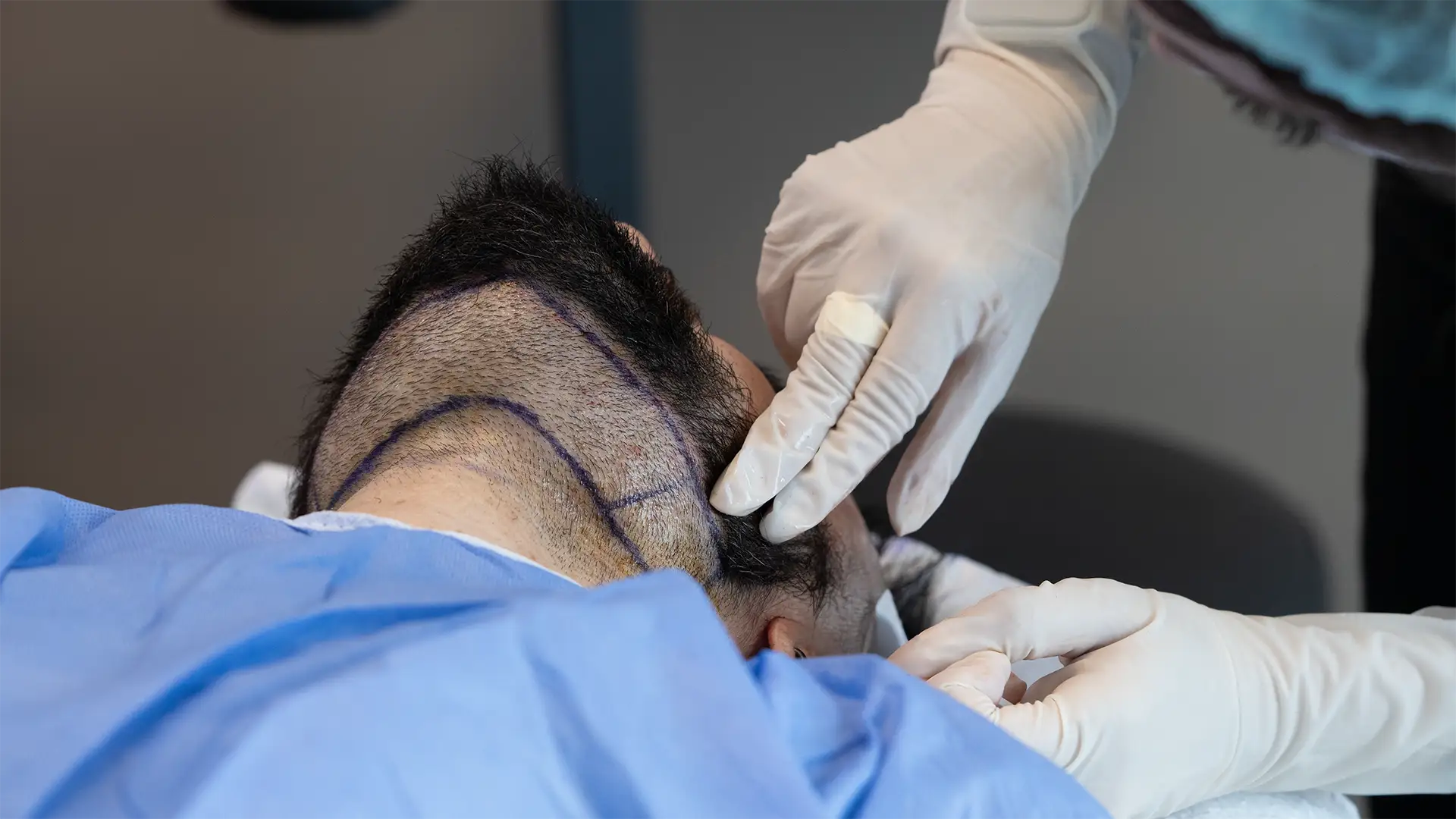 BHT hair transplant procedure using body hair follicles