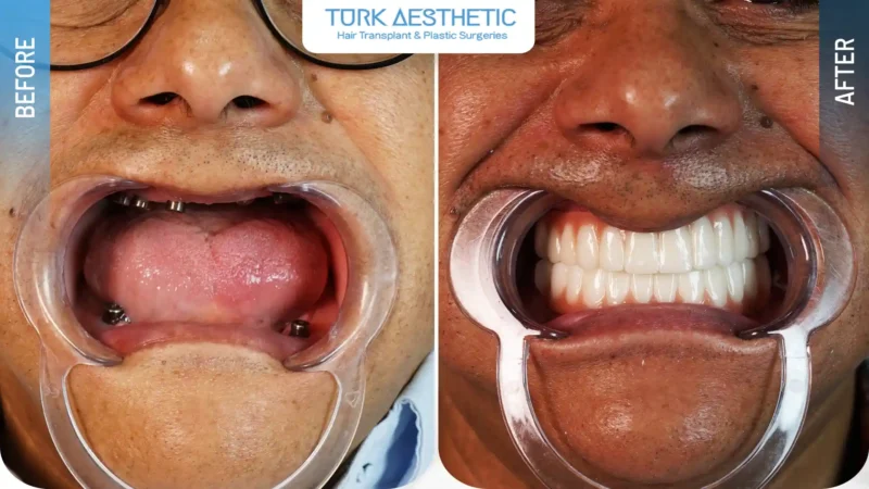 Prima e dopo la sostituzione dei denti mancanti con impianti dentali