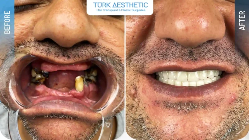 Ricostruzione del sorriso con impianti dentali prima e dopo