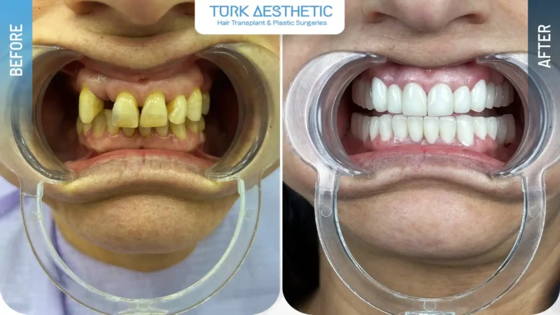 Aspetto dei denti prima e dopo il trattamento con impianti dentali