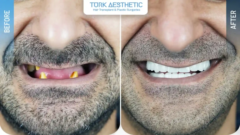 Trattamento dei denti mancanti con impianti dentali prima e dopo