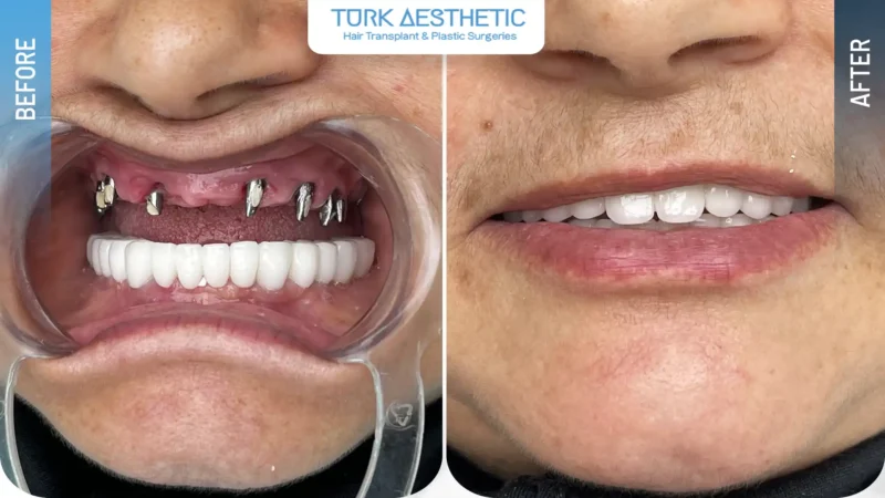 Risultato naturale del sorriso prima e dopo il trattamento con impianti dentali