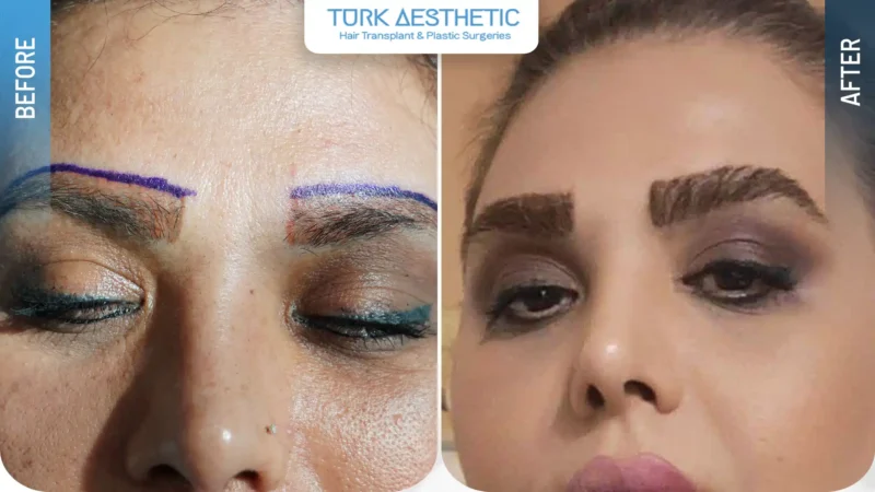 نتیجه ابروهای پرپشتتر و طبیعی پس از کاشت ابرو در ترکیه