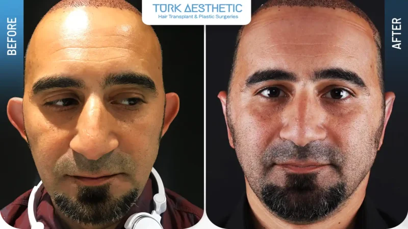 Kepçe kulak estetiği öncesi ve sonrası görünüm