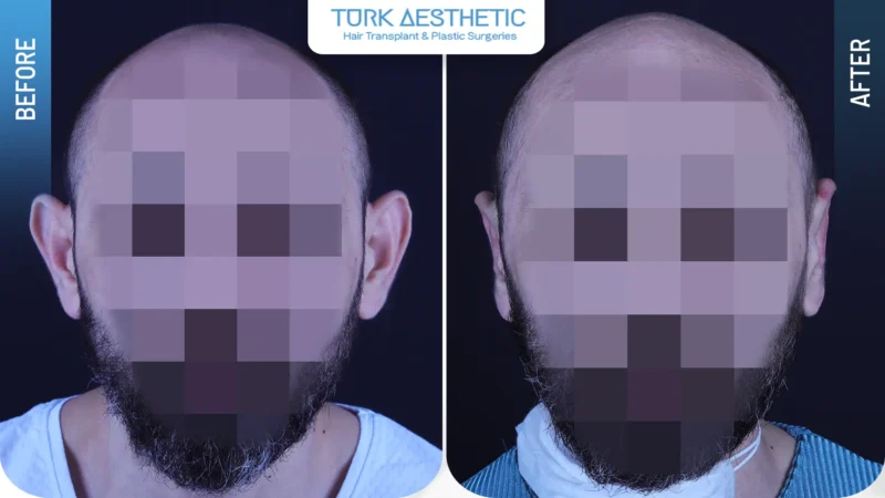 Kepçe kulak estetiği öncesi ve sonrası doğal sonuç