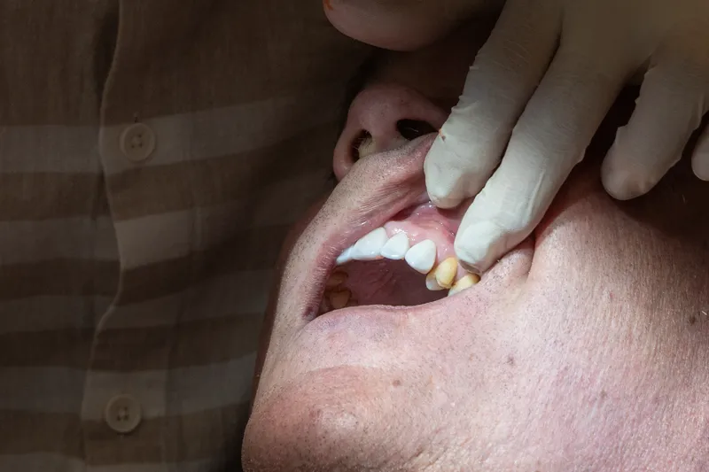 Lamine diş kaplama öncesi veneer provası ve estetik kontrol